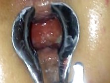 Anal Speculum Stretching