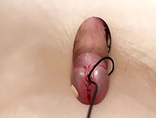 Maggots Urethra