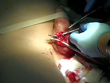 Orchiectomy Is Done To Remove Libido