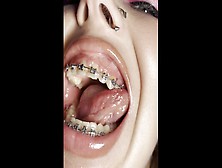 Metal Mouth Tour.  Schoolgirl With Braces Showing Her Uvula