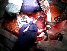 Open Thoracoabdominal Aortic Aneurysm Repair 14 Cm. Flv