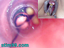 Old Woman Peehole Endoscope Online Cam In Bladder With Balls