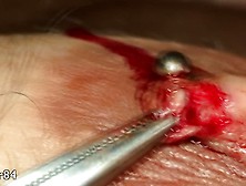 Removing A Part Of My Split Nipple