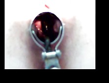 Leech In Speculum Opened Pussy