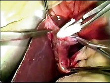 Colon Cyst Resection Young Argentinian Woman