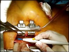 Less Invasive Implantation Left Ventricular Assist